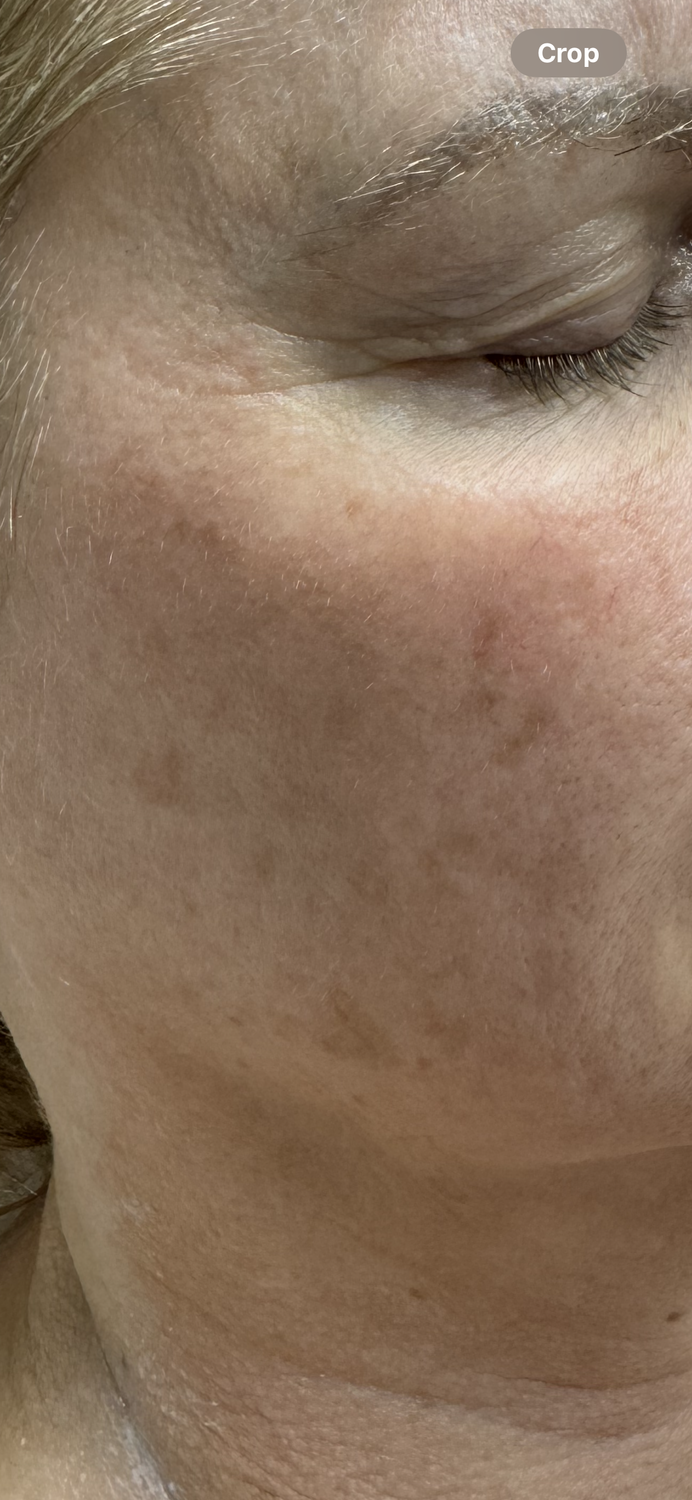 Laser Skin Rejuvenation After