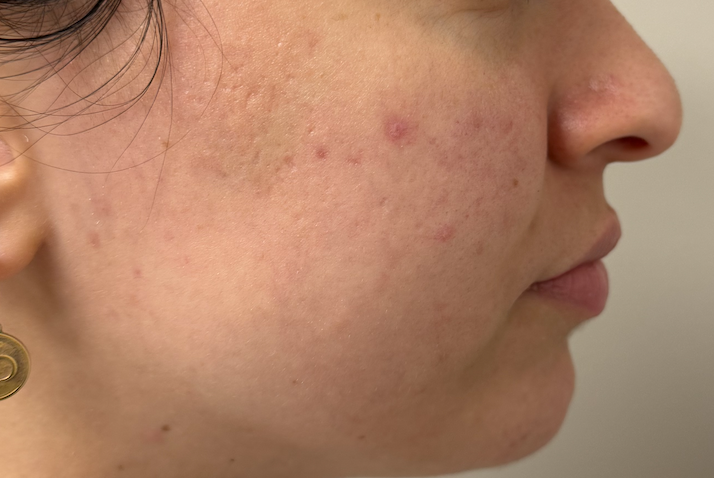 Laser Skin Rejuvenation Before