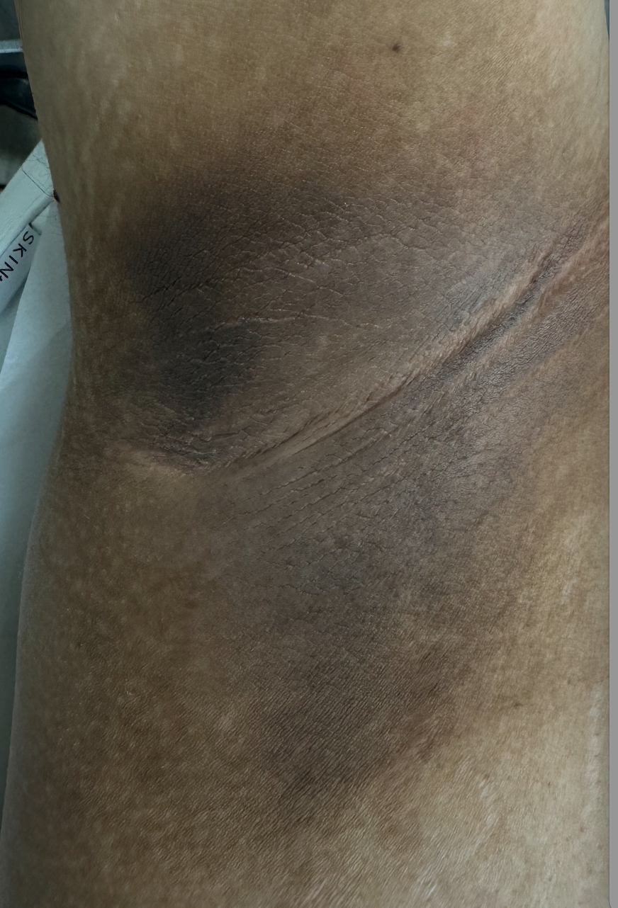 Laser Skin Rejuvenation Before