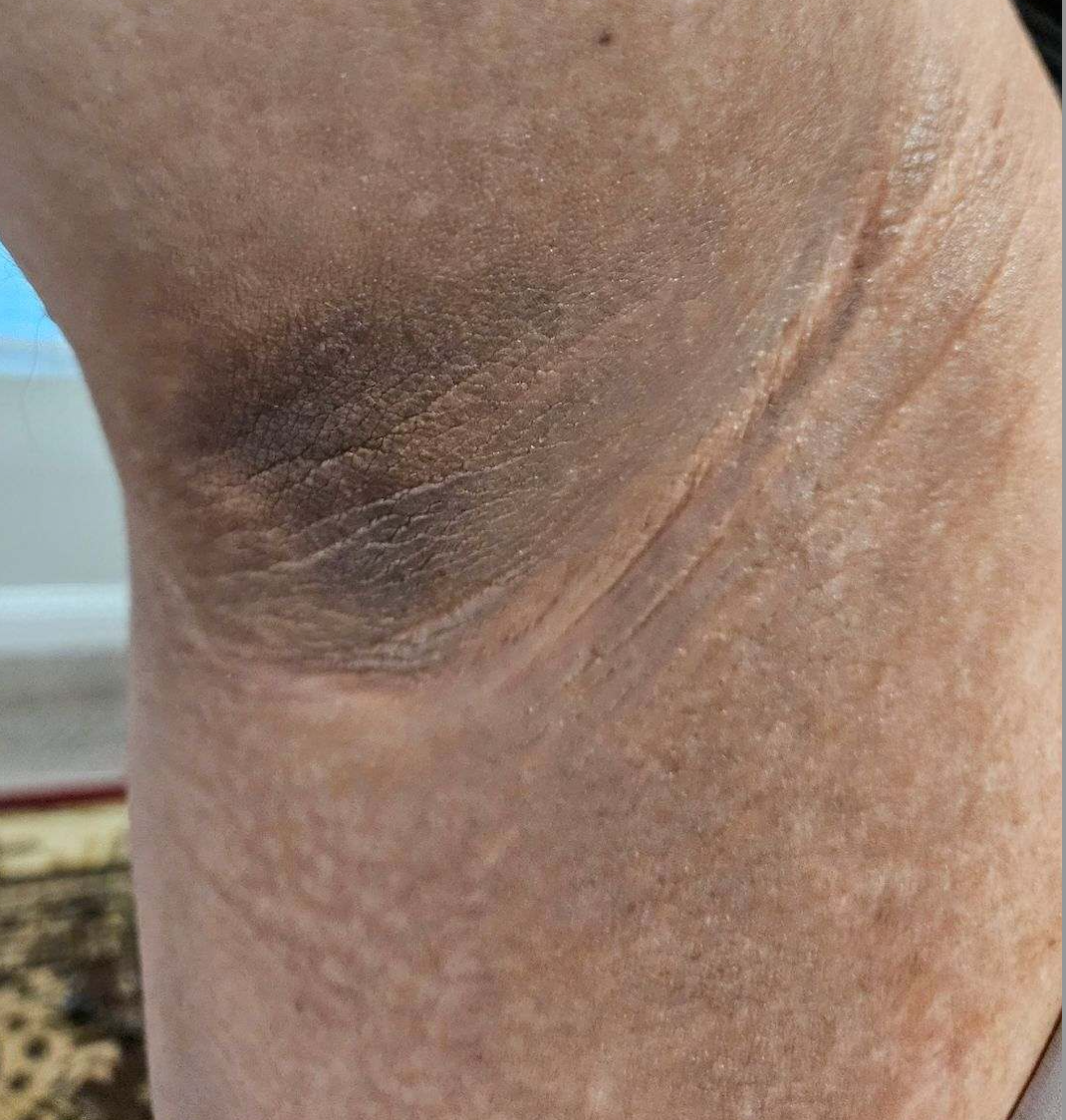 Laser Skin Rejuvenation After