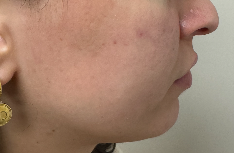 Laser Skin Rejuvenation After