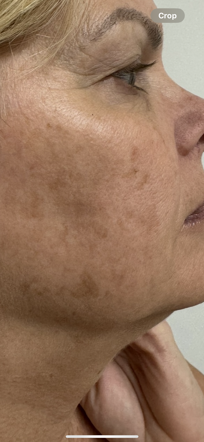 Laser Skin Rejuvenation Before