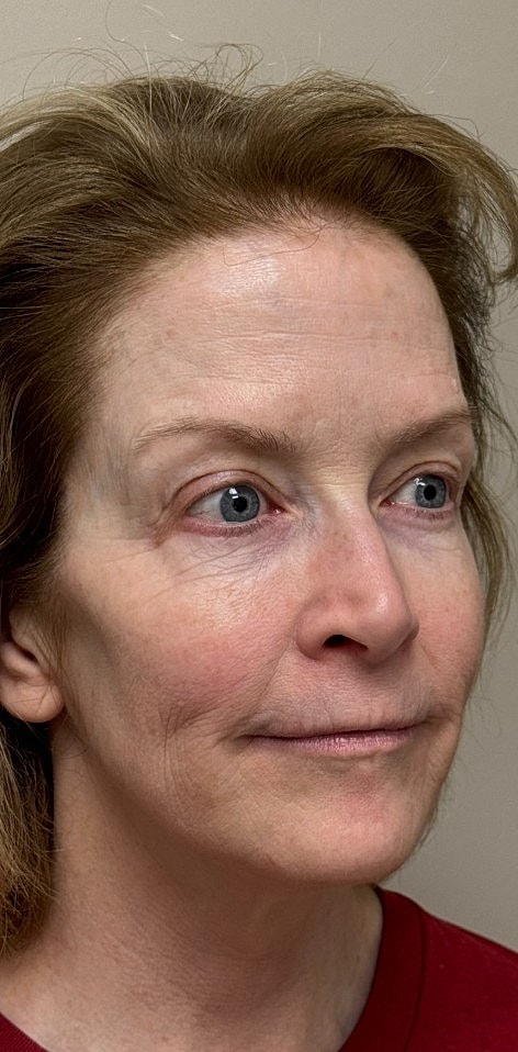 Laser Skin Rejuvenation Before & After