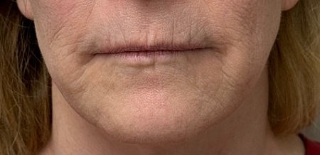 Laser Skin Rejuvenation Before & After
