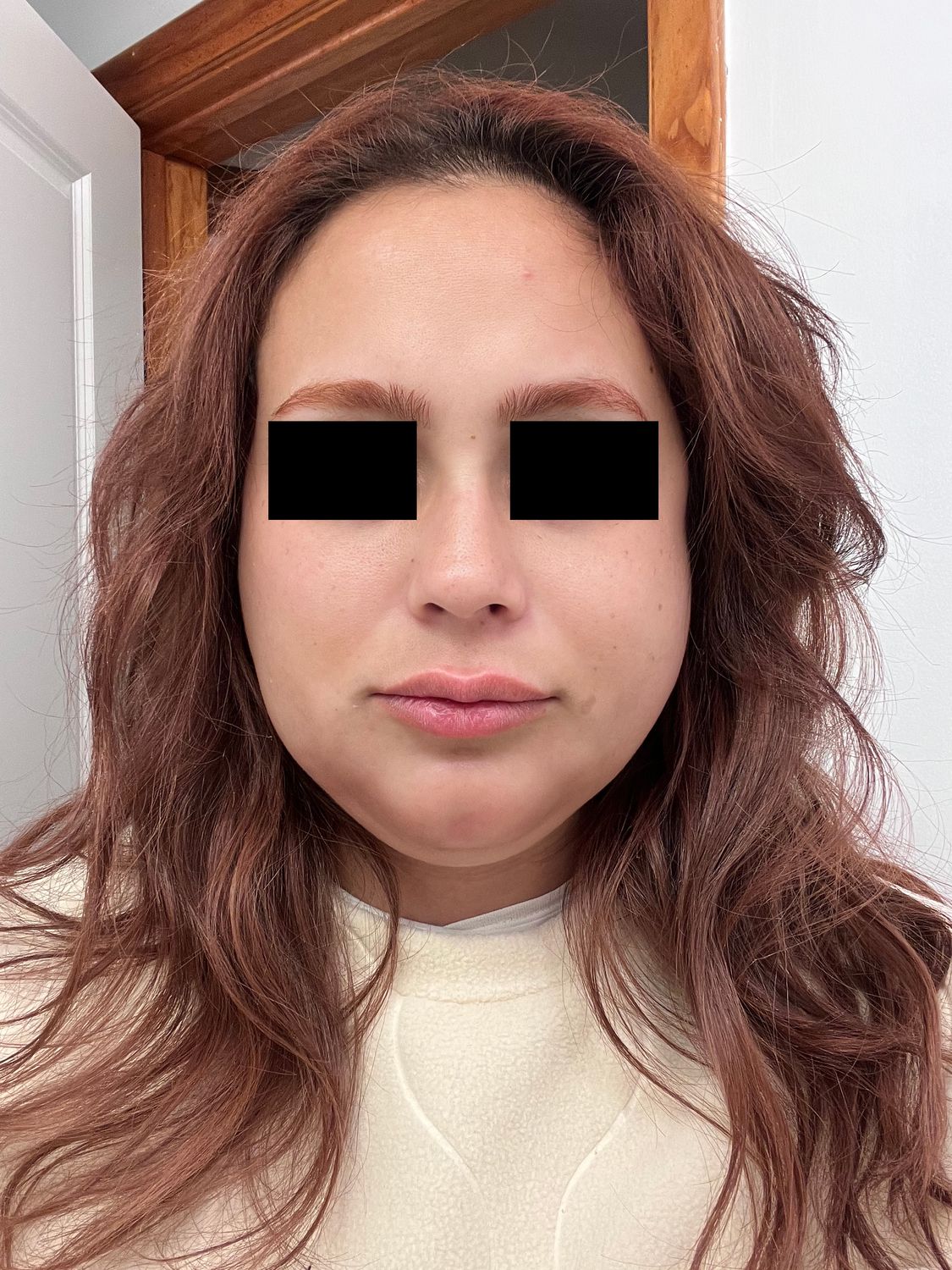 Ultrasound Guided Dissolve Before