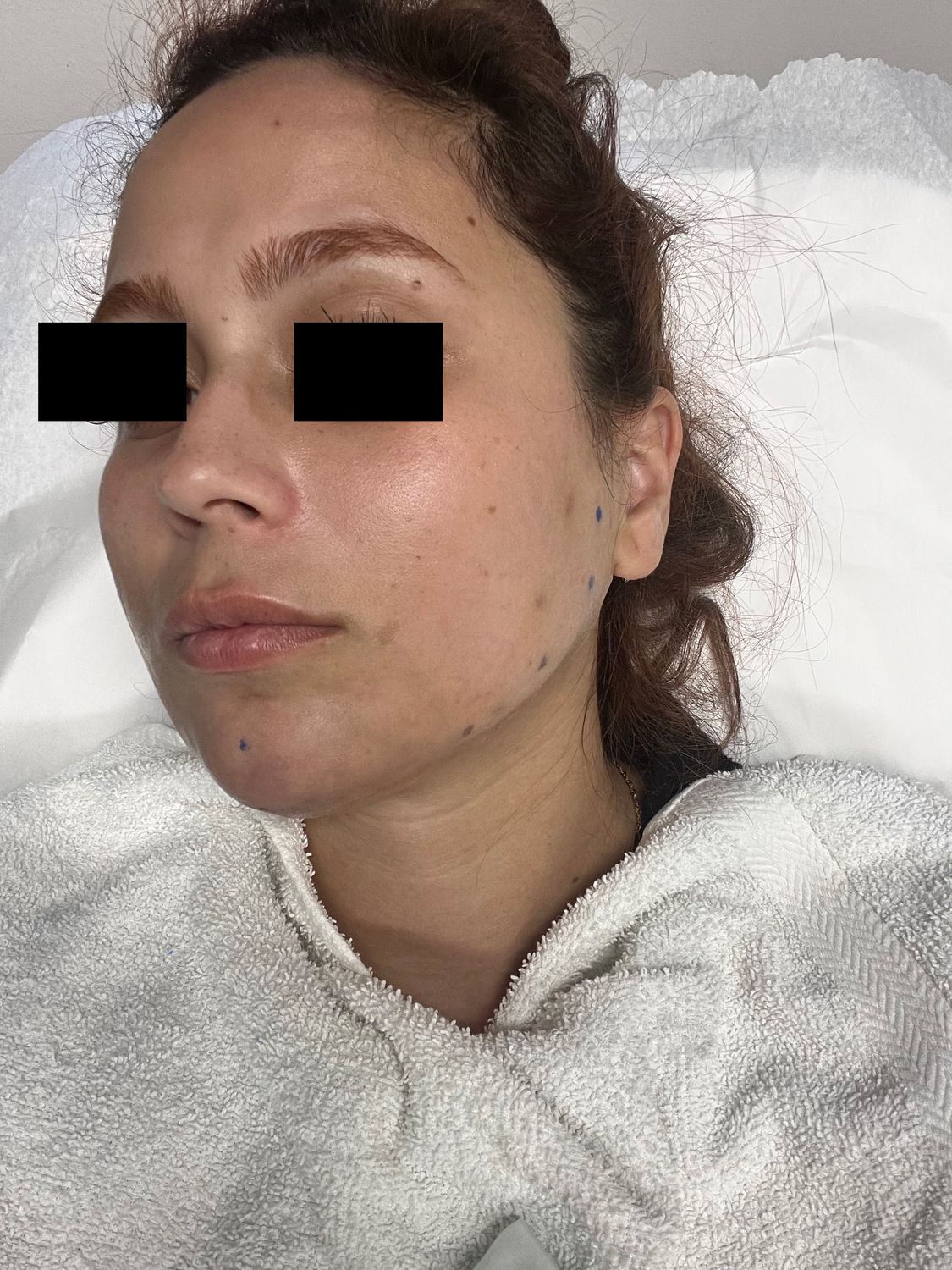 Ultrasound Guided Dissolve After