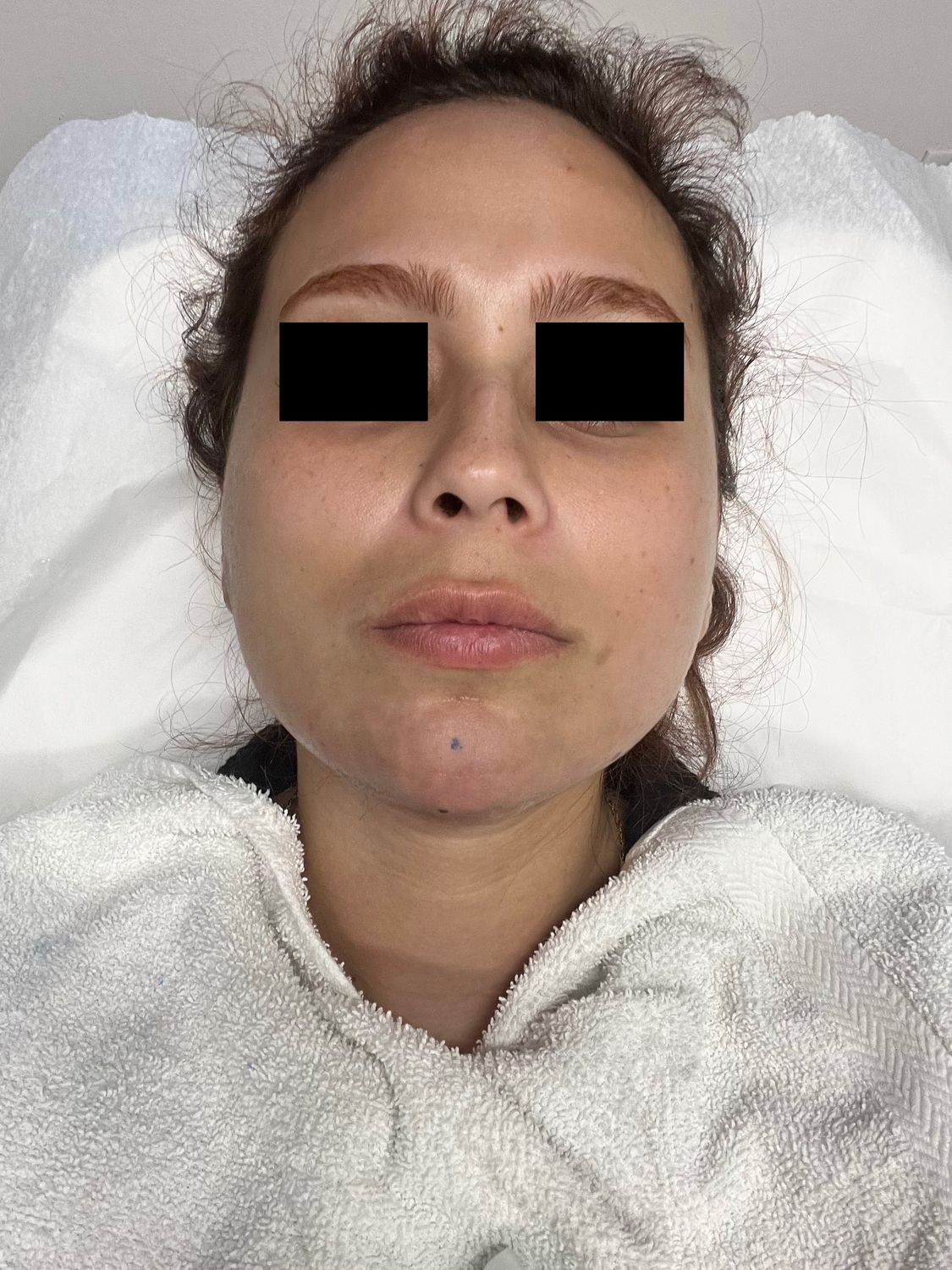 Ultrasound Guided Dissolve After