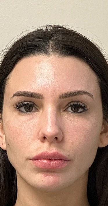 Ultrasound Guided Filler Dissolve Gallery Before & After