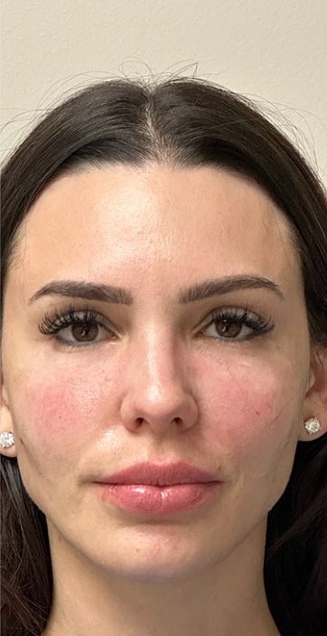 Ultrasound Guided Filler Dissolve Gallery Before & After