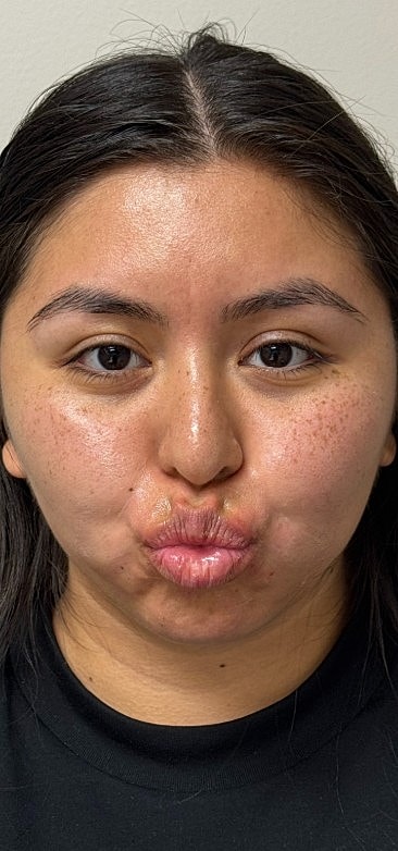 Ultrasound Guided Filler Dissolve Gallery Before & After