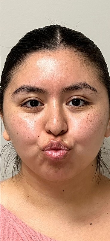 Ultrasound Guided Filler Dissolve Gallery Before & After