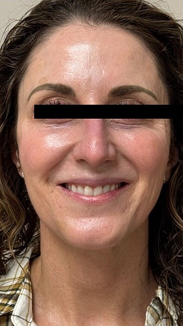 Ultrasound Guided Filler Dissolve Gallery Before & After