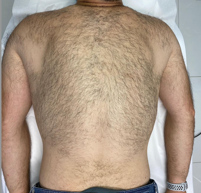 Laser Hair Removal Before