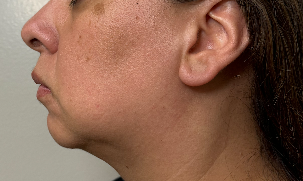 Dermal Fillers Gallery Before & After