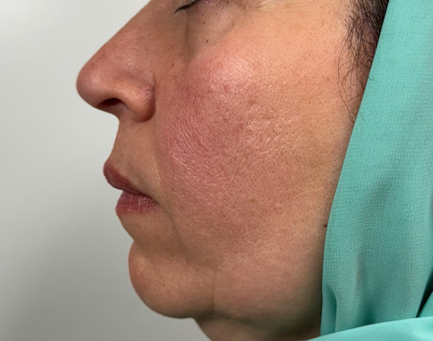 Dermal Fillers Gallery Before & After