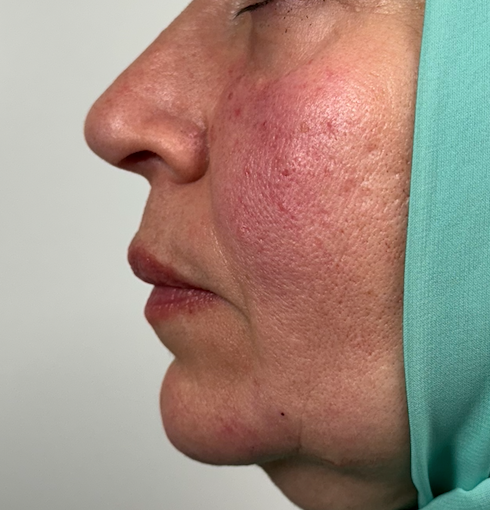 Dermal Fillers Gallery Before & After