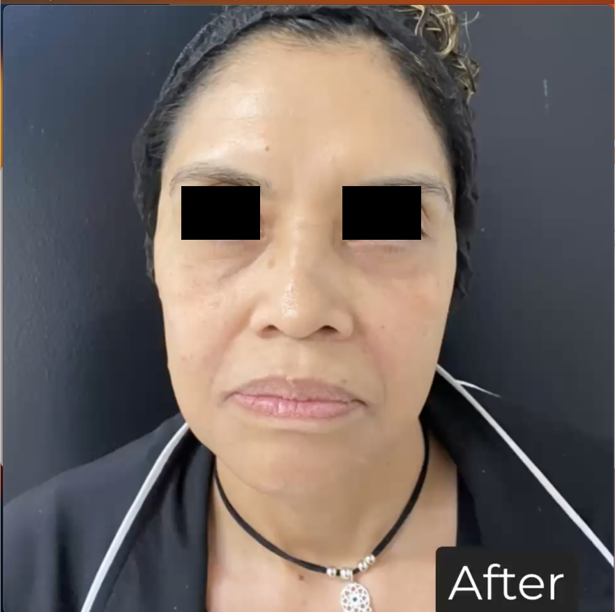 Dermal Fillers Gallery Before & Afters