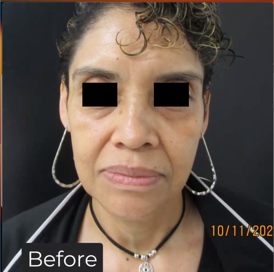 Dermal Fillers Gallery Before & Afters