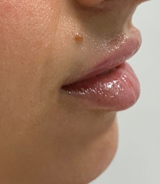 Dermal Fillers Gallery Before & After