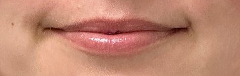 Dermal Fillers Gallery Before & After