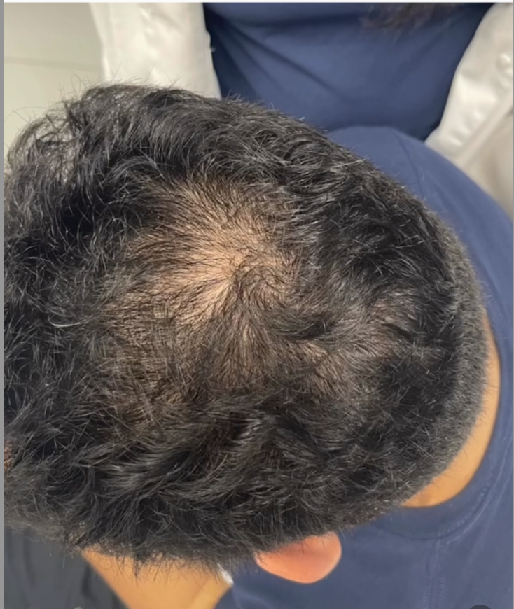 PRP Hair Restoration Before