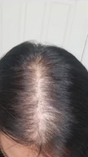 PRP Hair Restoration Before