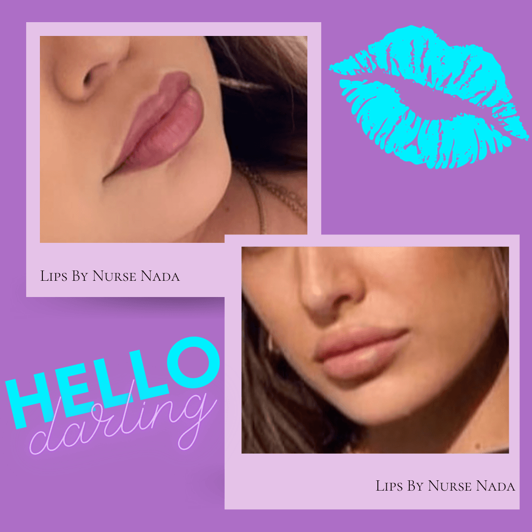 lip fillers before and after