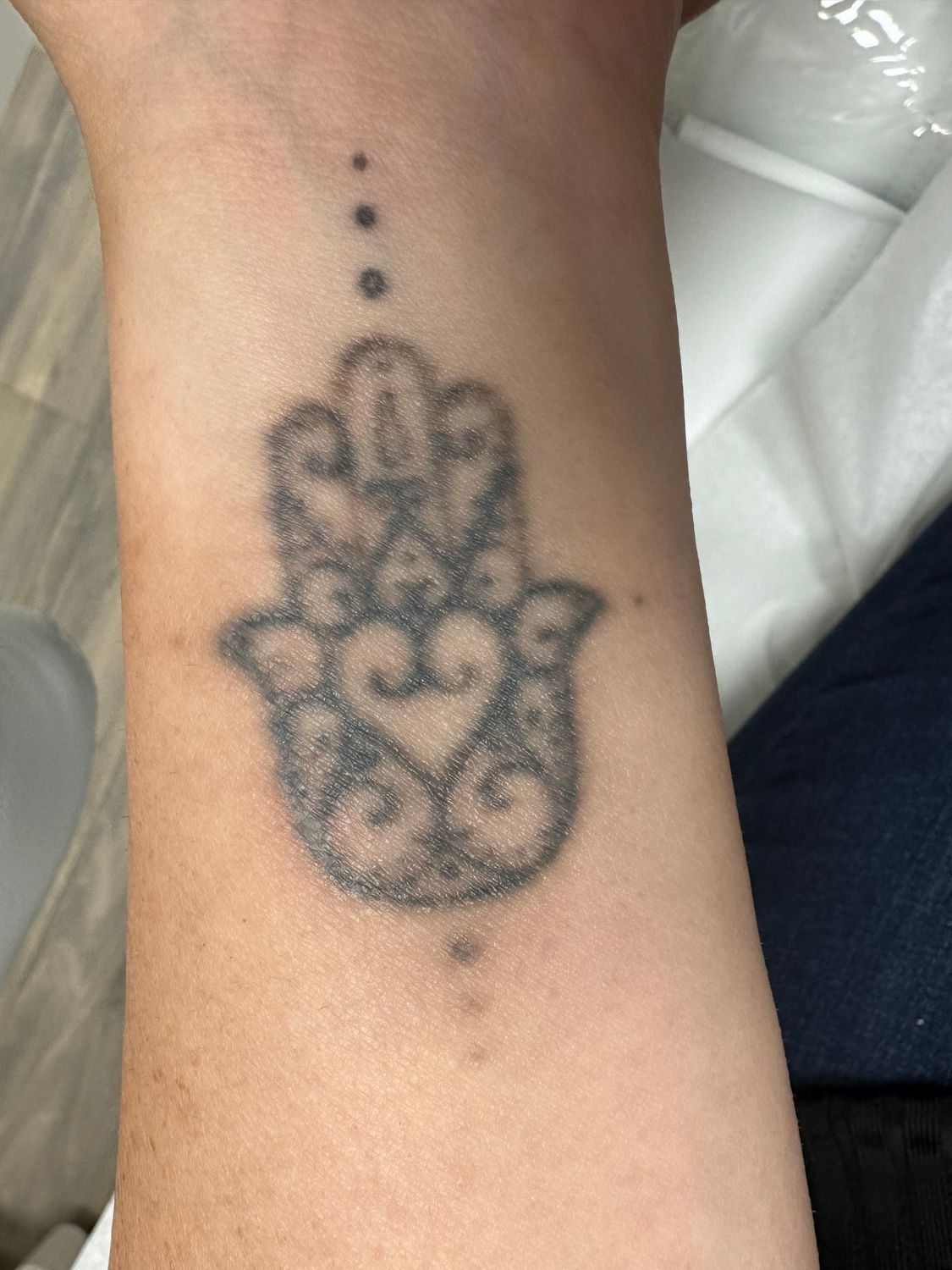 Tattoo Removal Gallery After