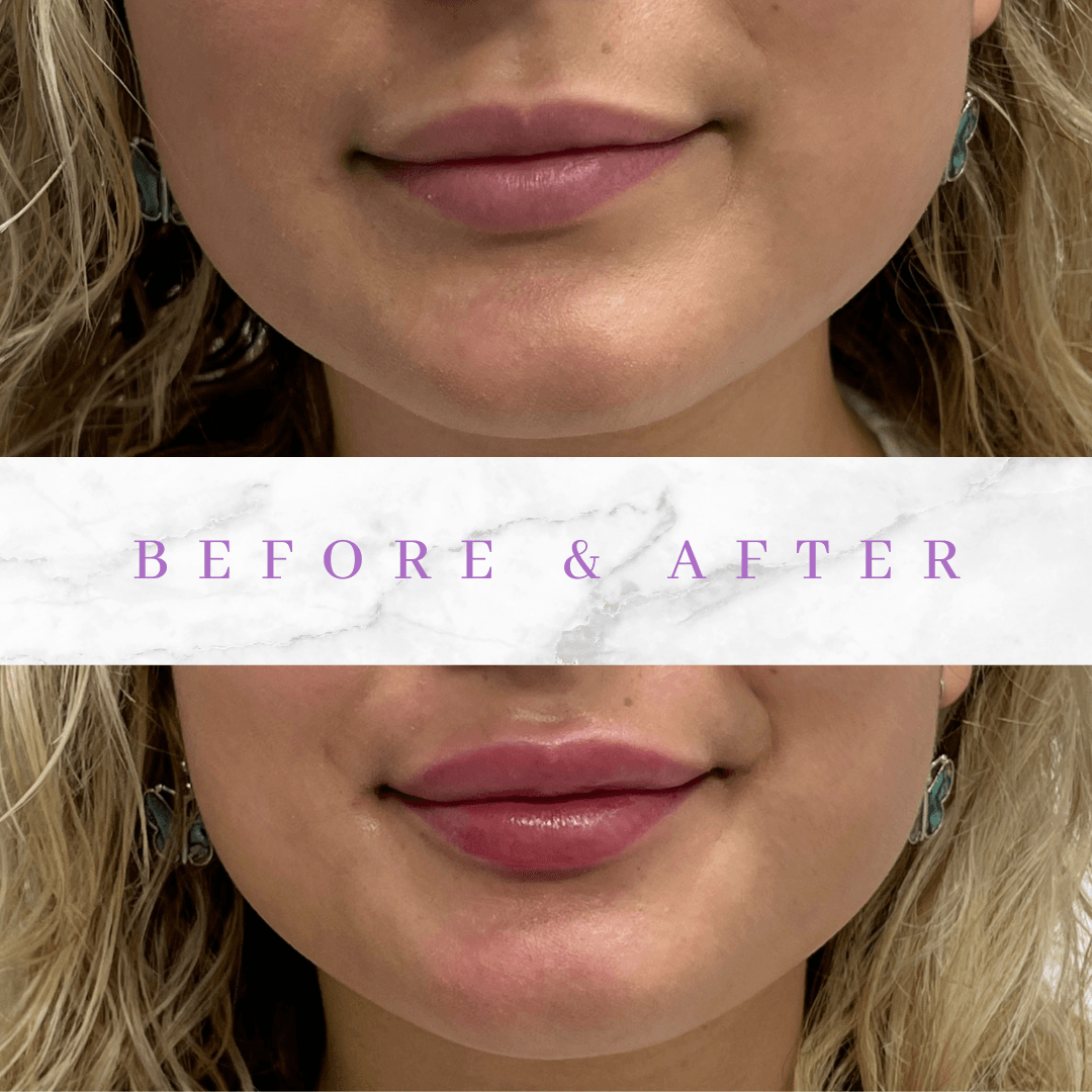 lip fillers before and after